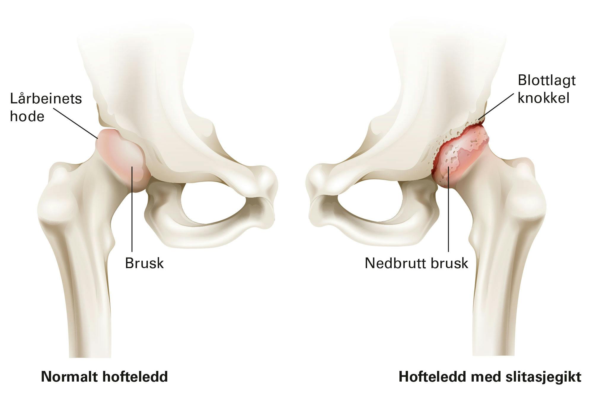 Grafisk fremstilling av hofteartrose