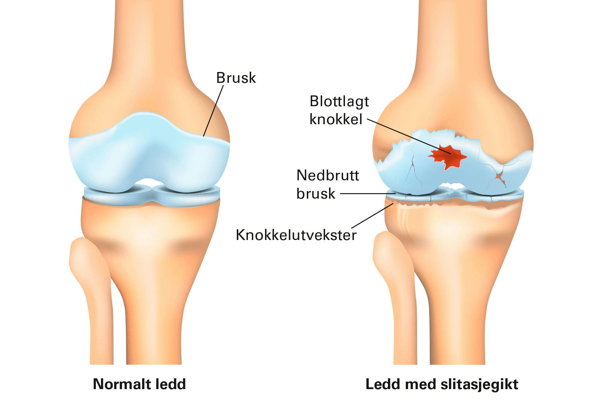 Grafisk fremstilling av slitasjegikt i kneleddet.