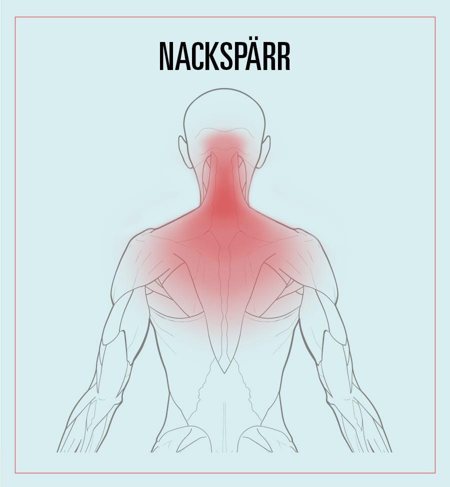 Illustration av smärta vid nackspärr