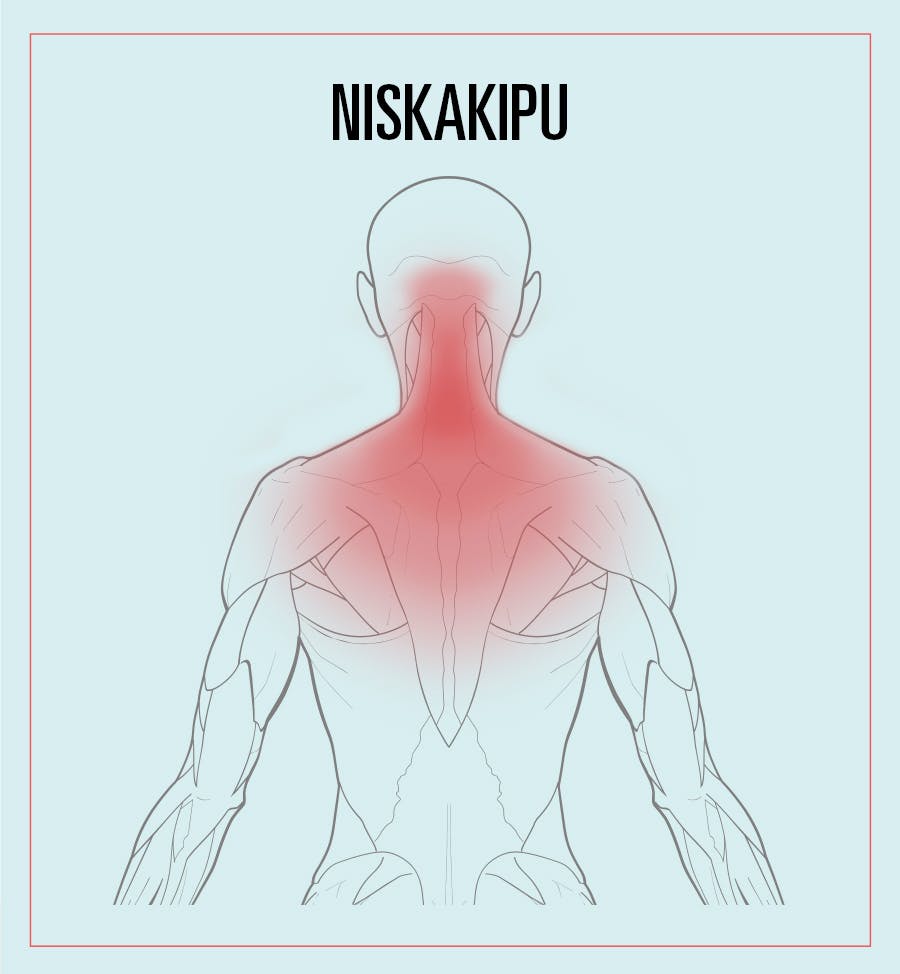 Piirroskuva niskakivun esiintymisalueesta.