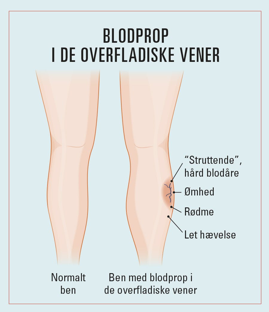 Illustration af ben med overfladisk blodprop i benet