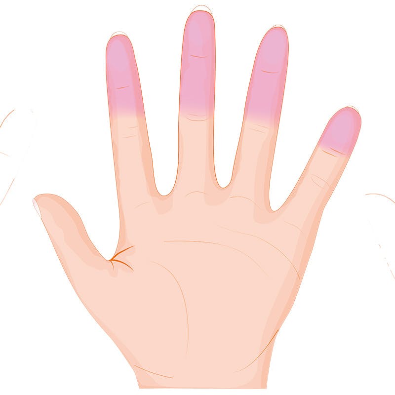 Grafiikka Raynaud’n ilmiö vaihe 2