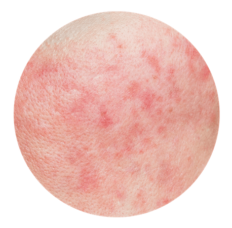 Rosacea set helt tæt på