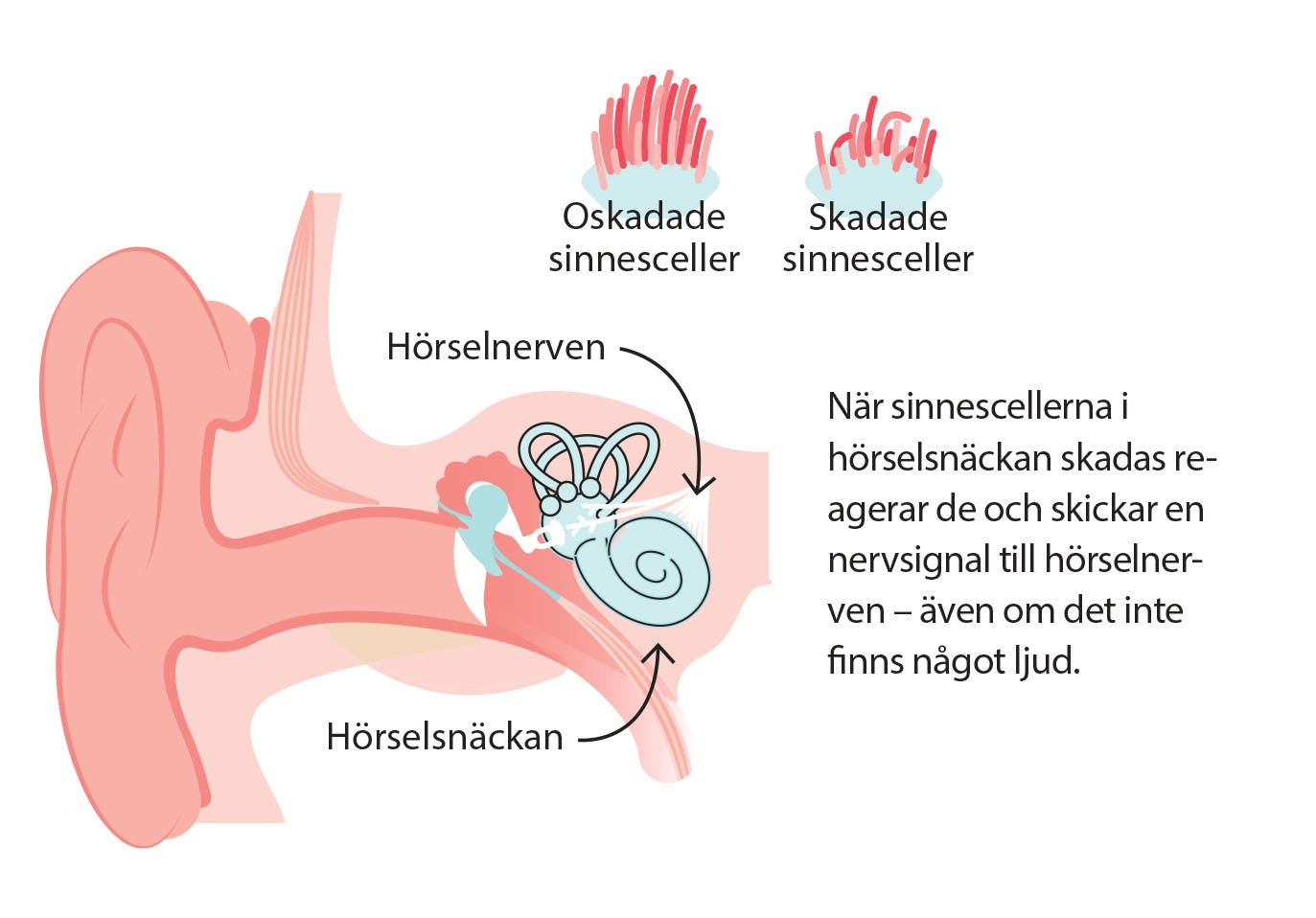 Illustration av varför det ringer i öronen