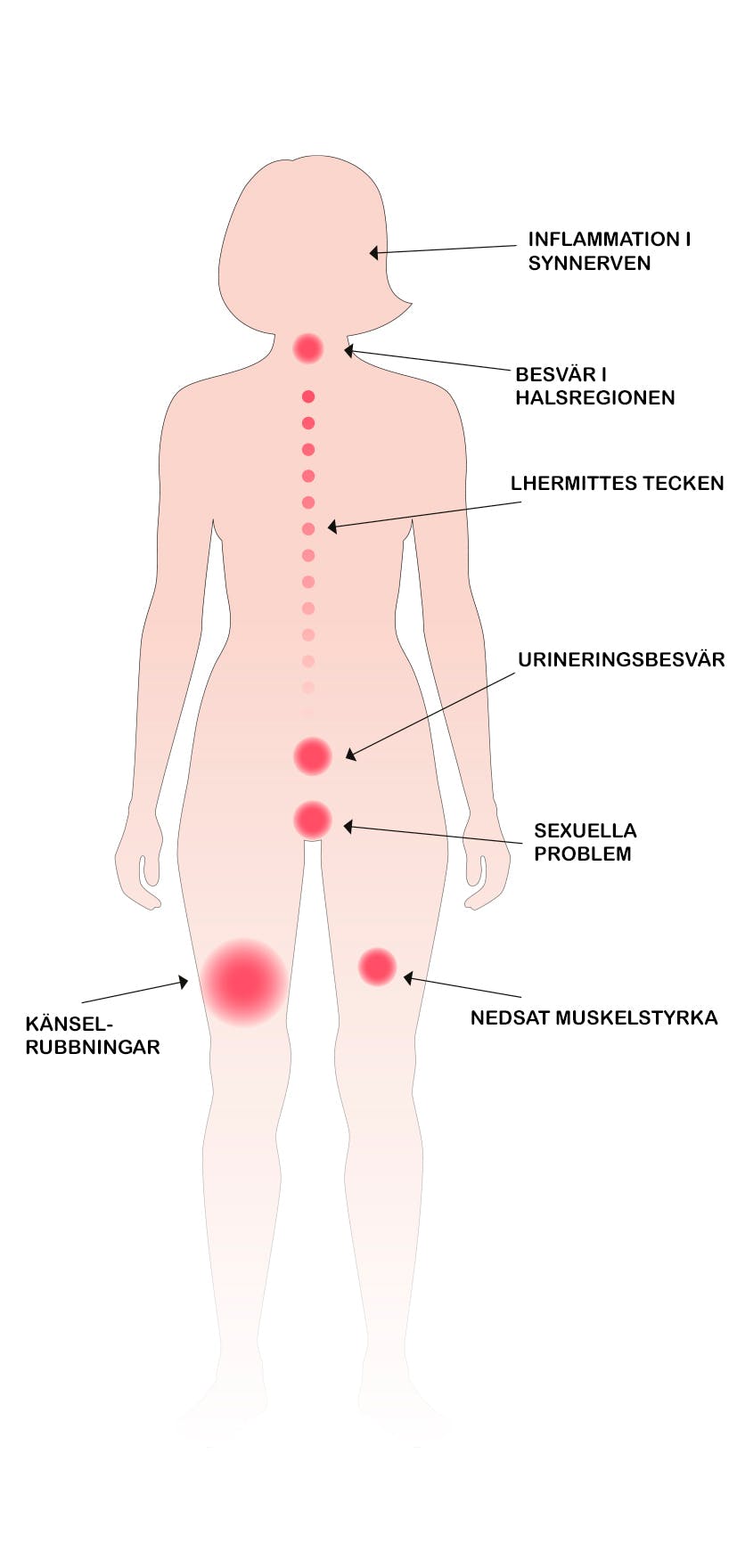 Illustration av symptom på multipel skleros