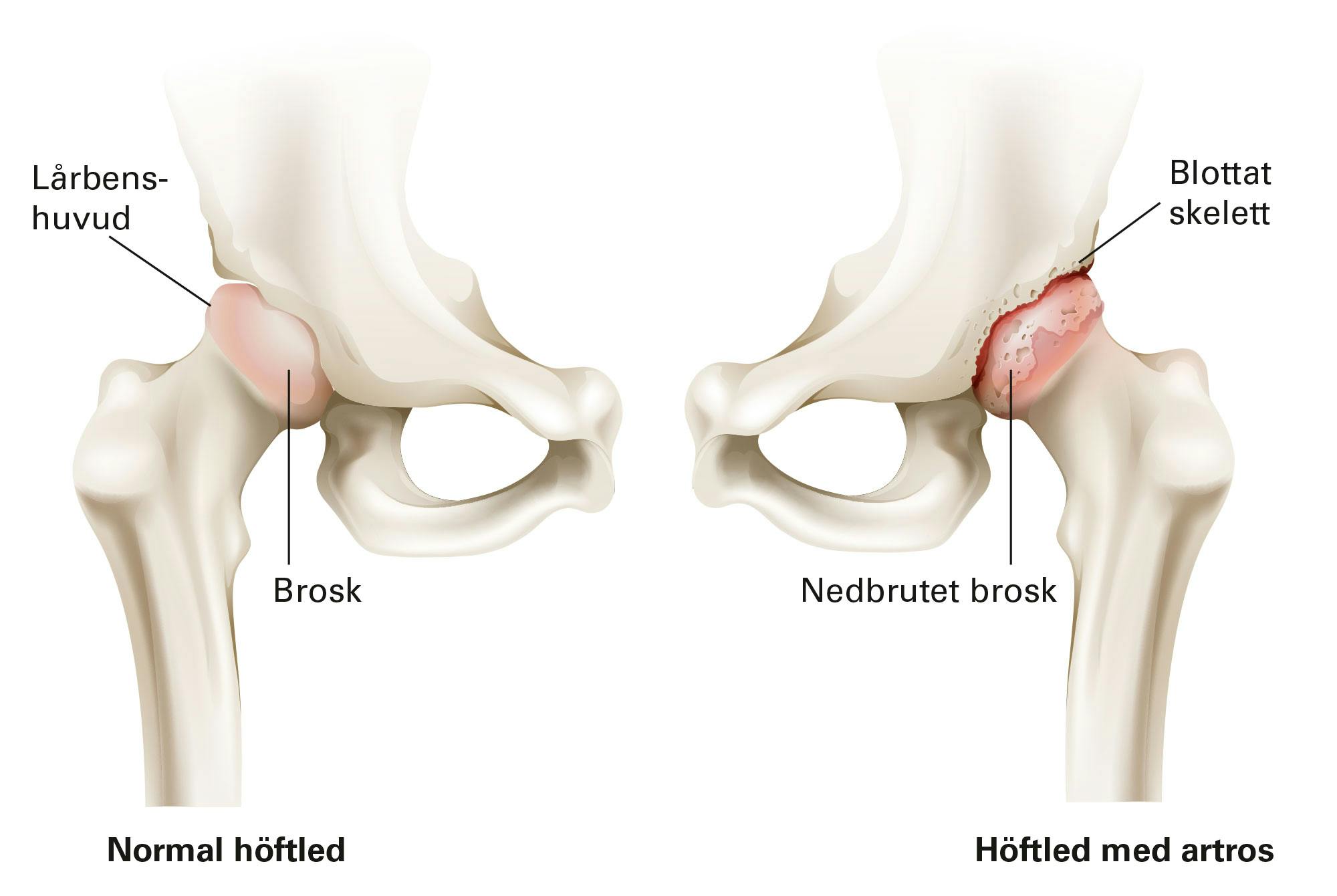 Grafik av artros i hoften