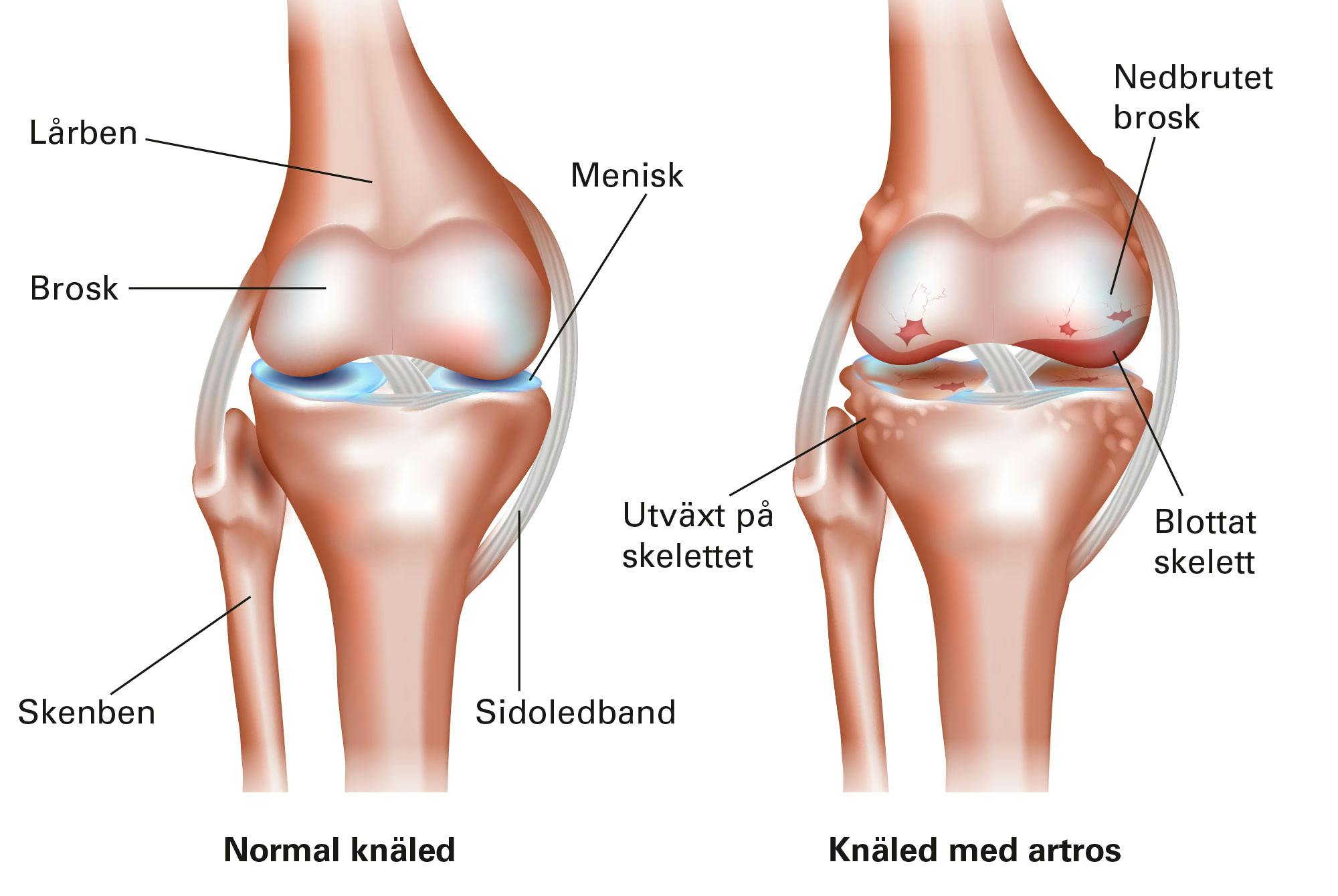 Grafik över artros i knäleden