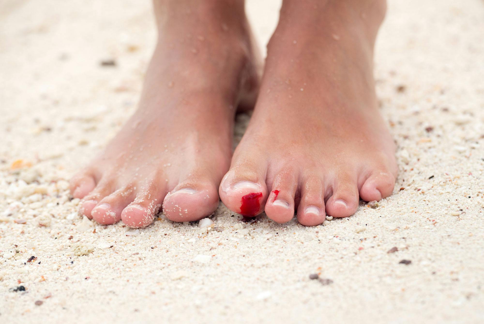 En fot med ett sår på en sandstrand.Är saltvatten sårrengörande?