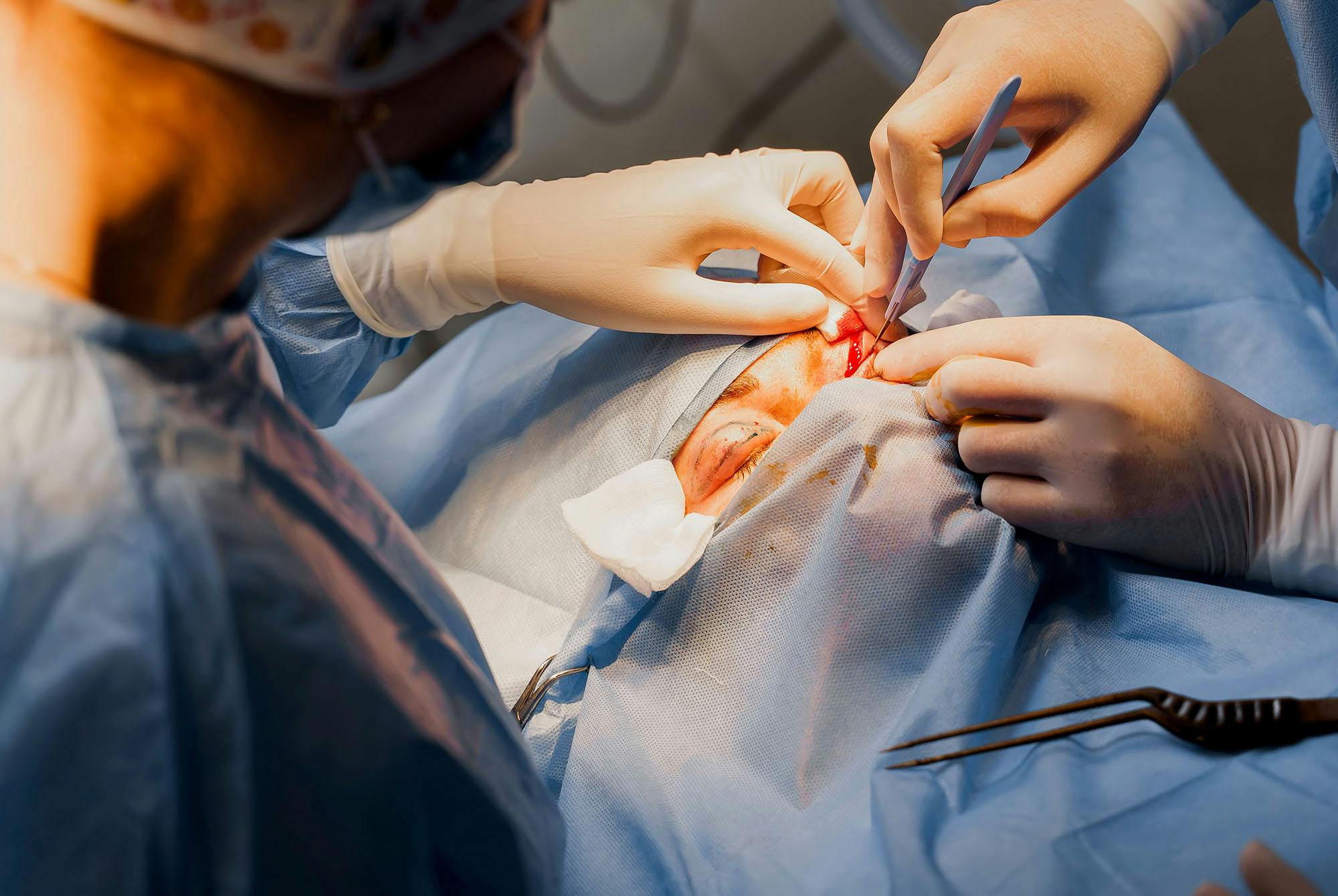 Silmäluomileikkaus – lääkäri tekee silmäluomileikkausta – leikkaa skalpellilla.