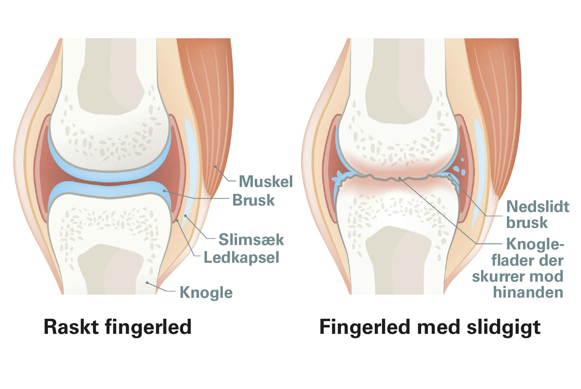Grafik af slidgigt i fingrene