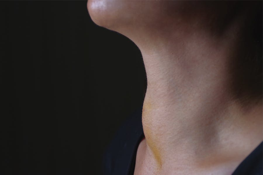 Kvinde med struma, lavt stofskifte - billeder af folk med lavt stofskifte