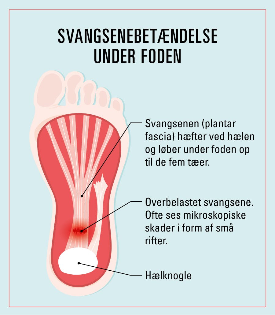 Havainnekuva jalkapohjan jännekalvon rappeumasta