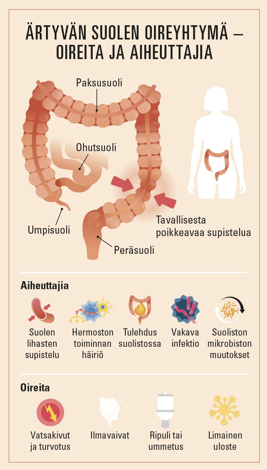 Piirroskuva, jossa esitetään ärtyvän suolen oireyhtymän (IBS) syitä ja oireita.
