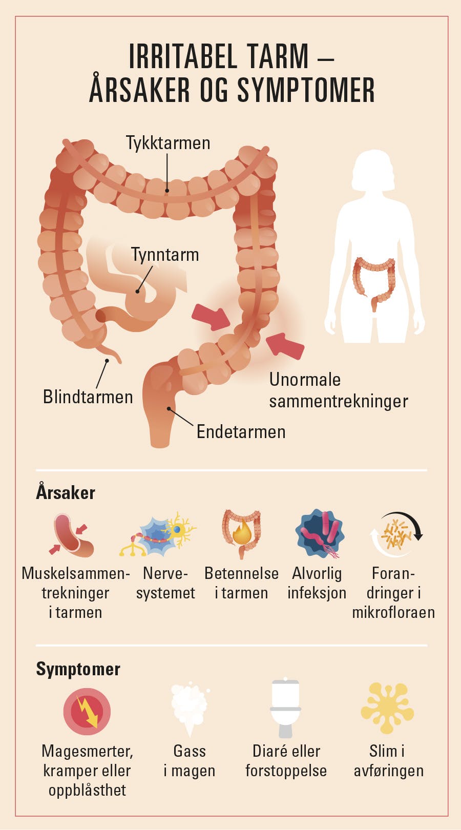 Grafikk/illustrasjon som viser årsaker til og symptomer på irritabel tarm-syndrom (IBS)