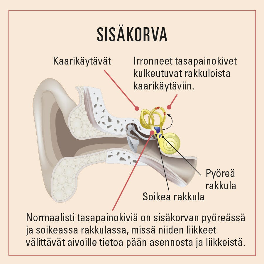 Tasapainokivet sisäkorvan kaarikäytävissä voivat aiheuttaa huimausta.