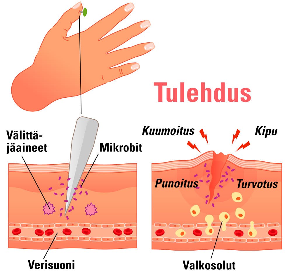 Piirros tulehdusreaktiosta, kun sormeen tulee haava