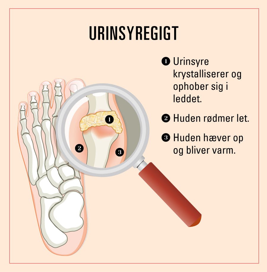 Urinsyregigt i fingrene hos en kvinde. Angreb i fødder hedder podgra.