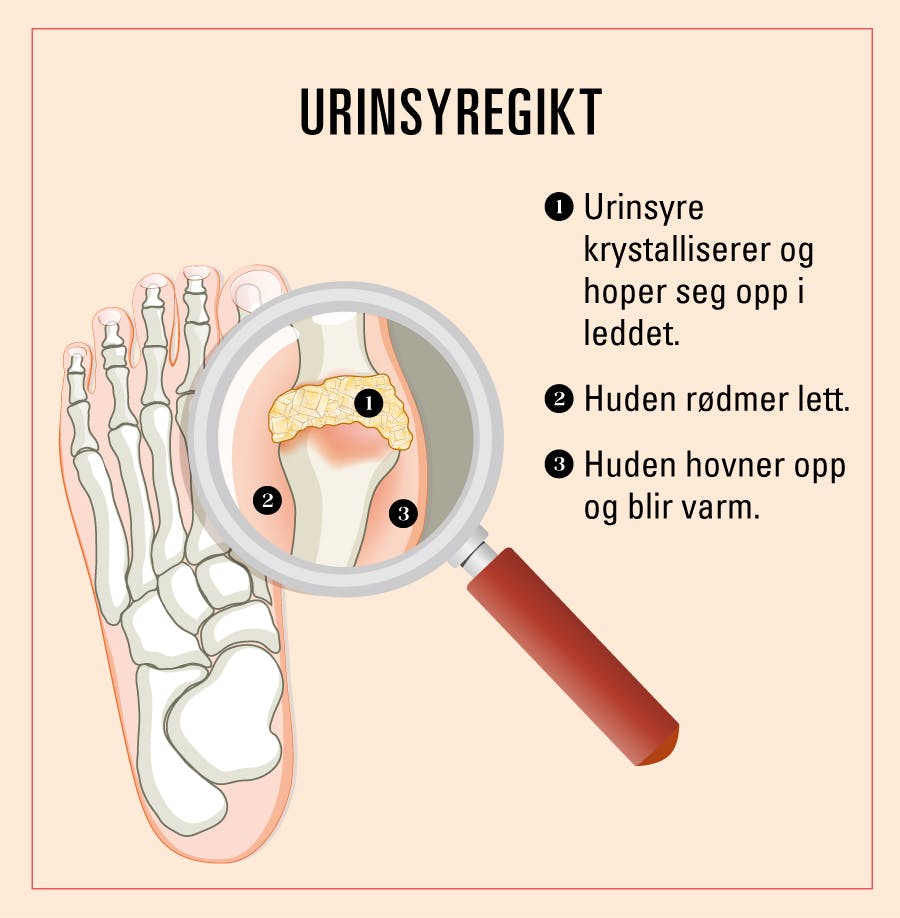 Urinsyregikt i fingrene hos en kvinne. Anfall i føttene kalles podagra.