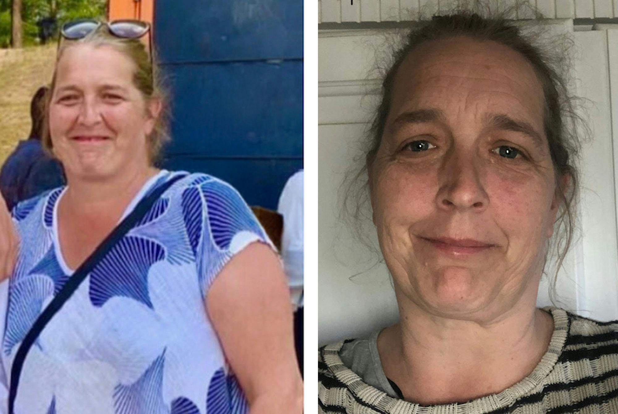 Louise ennen Wegovy-laihdutuslääkkeen aloittamista ja sen jälkeen.