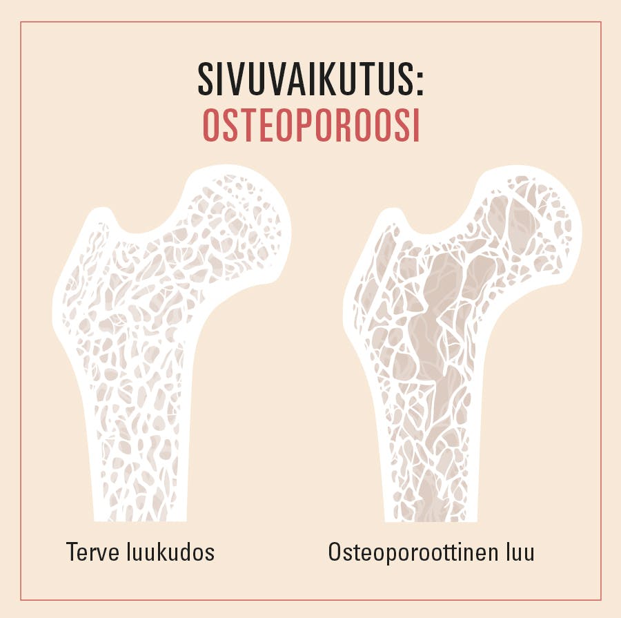 Luukato on wegovyn sivuvaikutus – havainnekuvassa terve luu ja osteoporoottinen luu