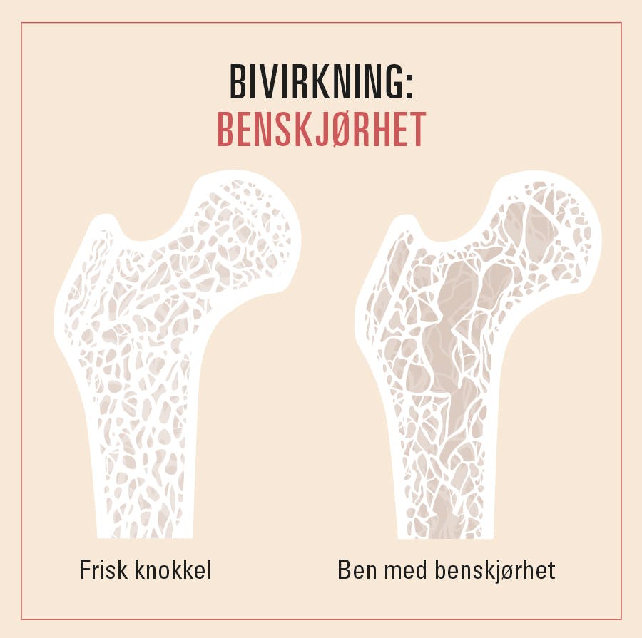 Beinskjørhet er en bivirkning av wegovy - illustrasjonen viser friske bein og bein med benskjørhet
