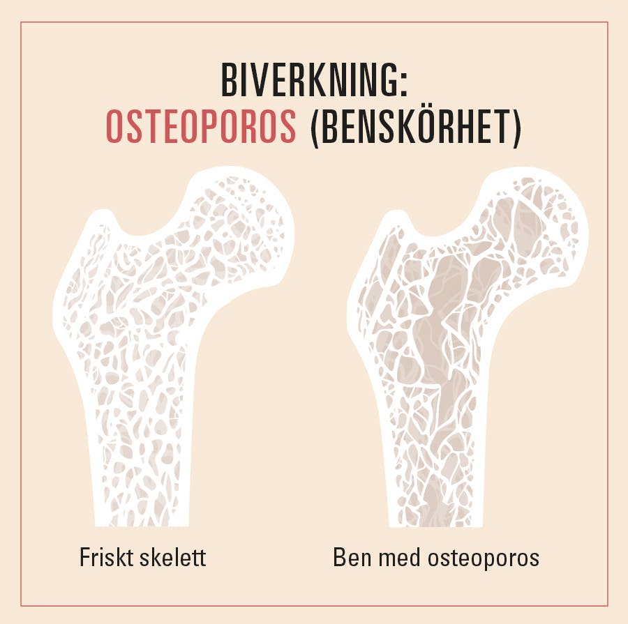 Osteoporos är en biverkning av wegovy - illustrationen visar friskt ben och ben med osteoporos