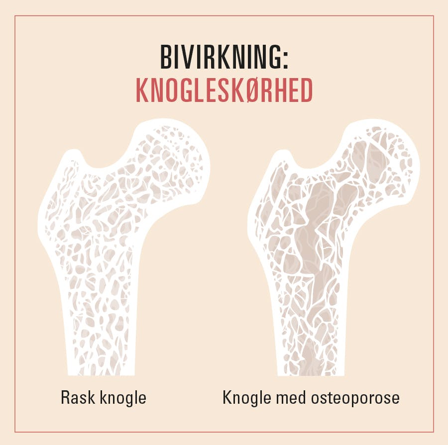 Knogleskørhed er en wegovy-bivirkning – illustration viser sund knogle og knogle med osteoporose