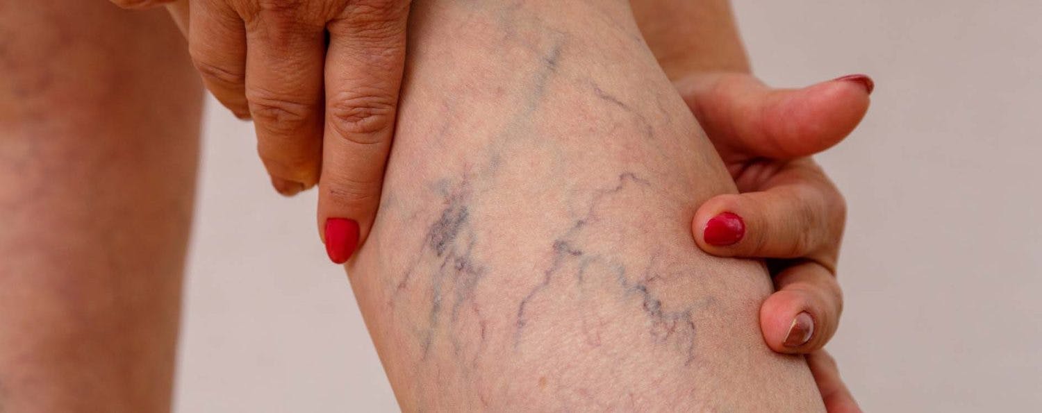 Kvinnebein med åreknuter