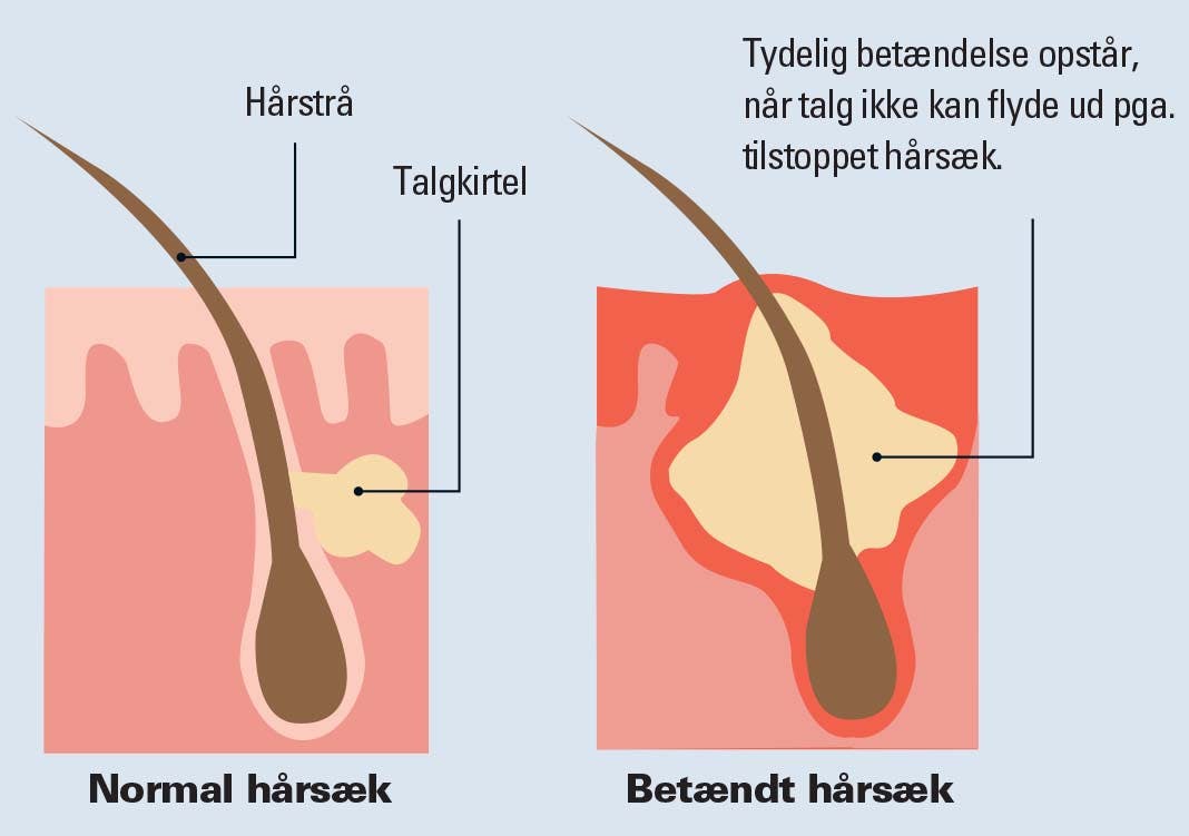 grafik af hvordan akne / bumser opstår
