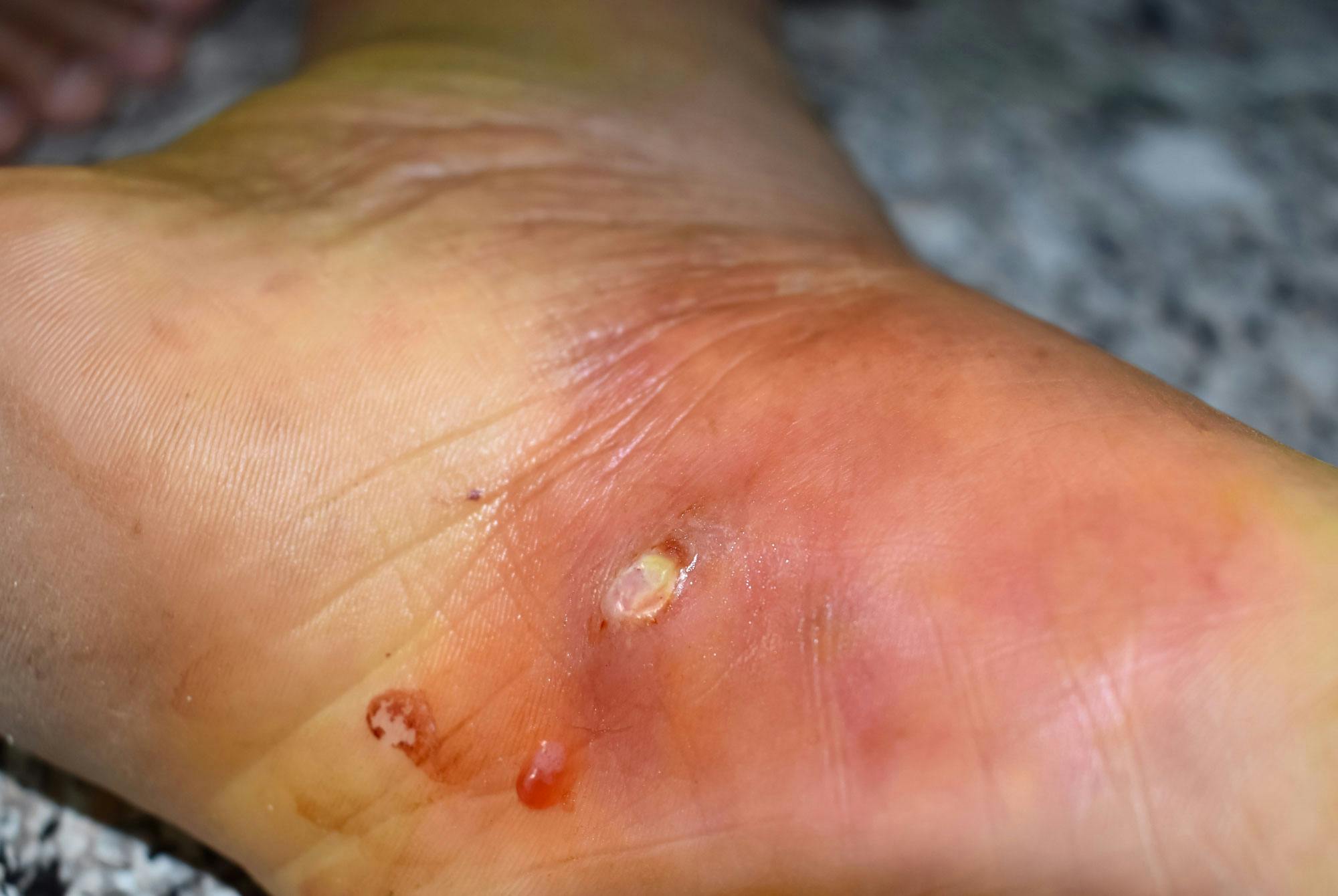 cellulittbyll med omkringliggende betennelse i de underliggende hudlagene