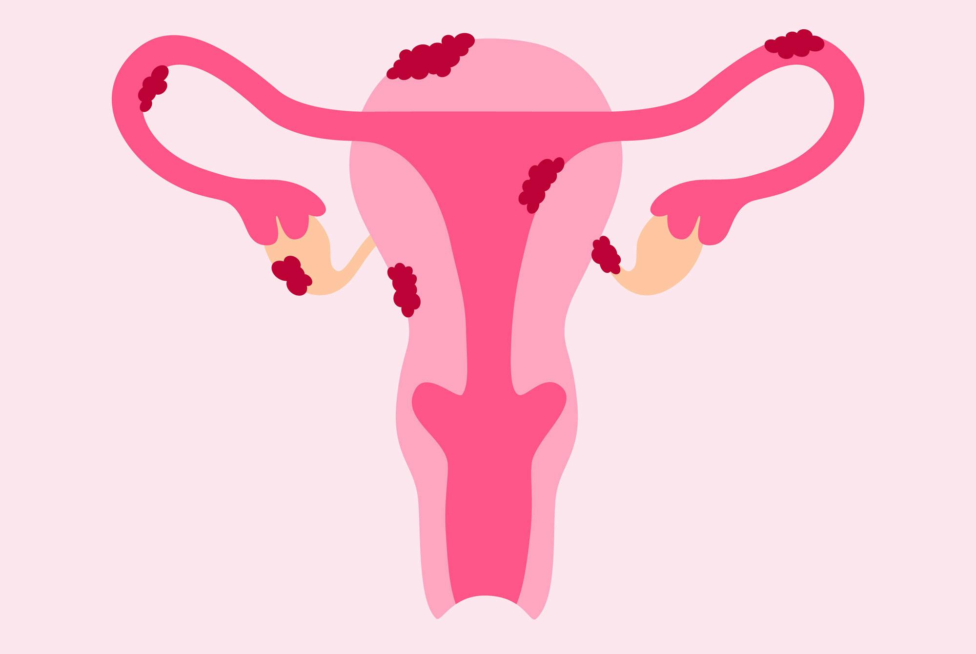 illustrationen visar chokladcystor i livmodern