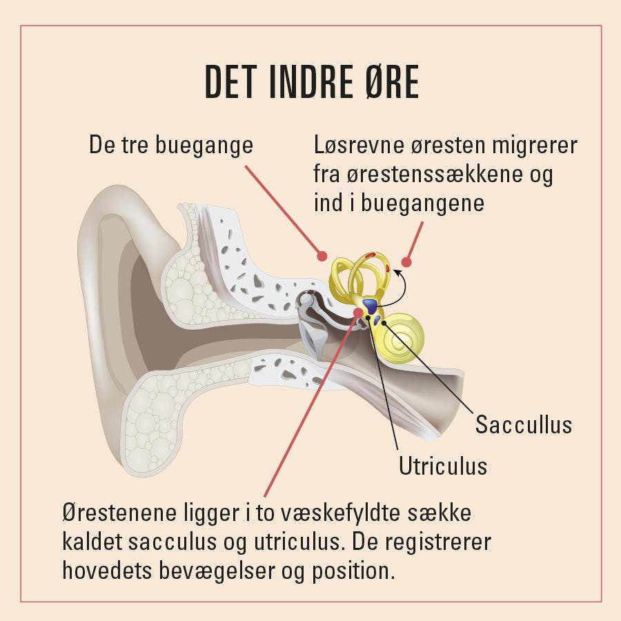 illustration af øresten som kan give svimmelhed
