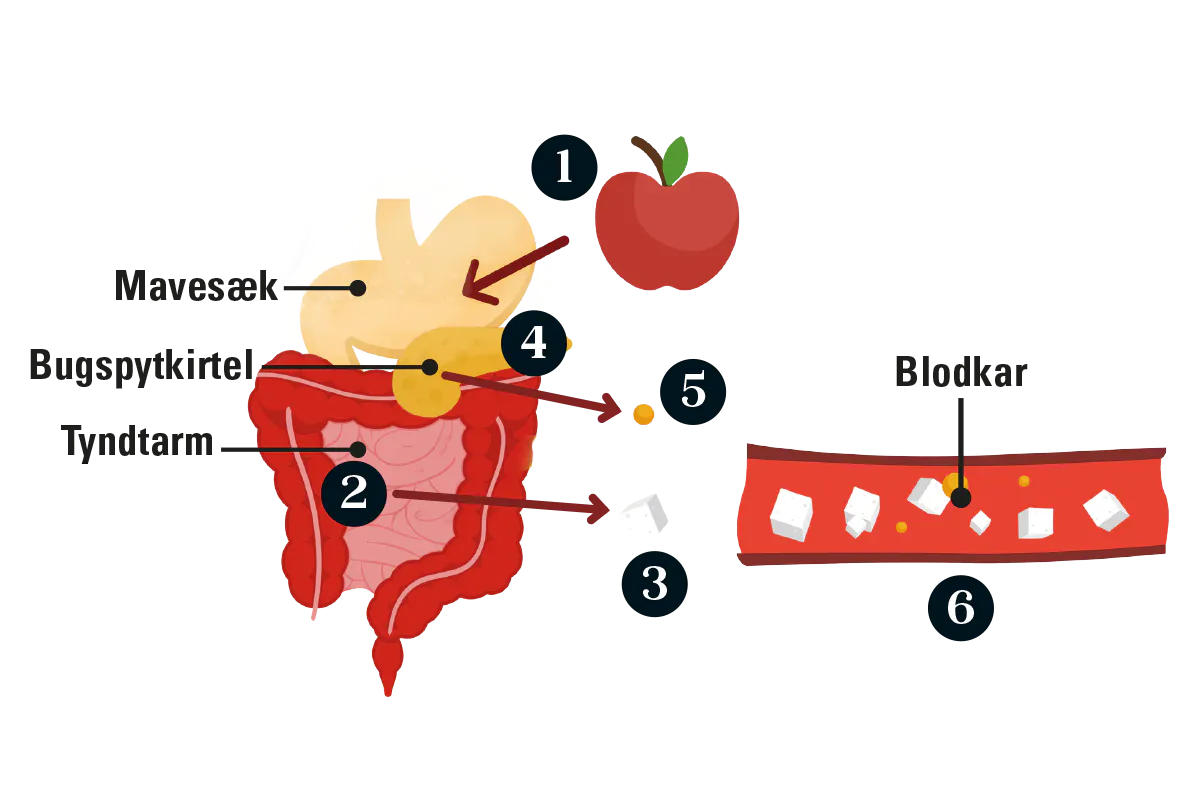 grafik, der viser, hvad der sker der i kroppen hos en patient med type 2-diabetes