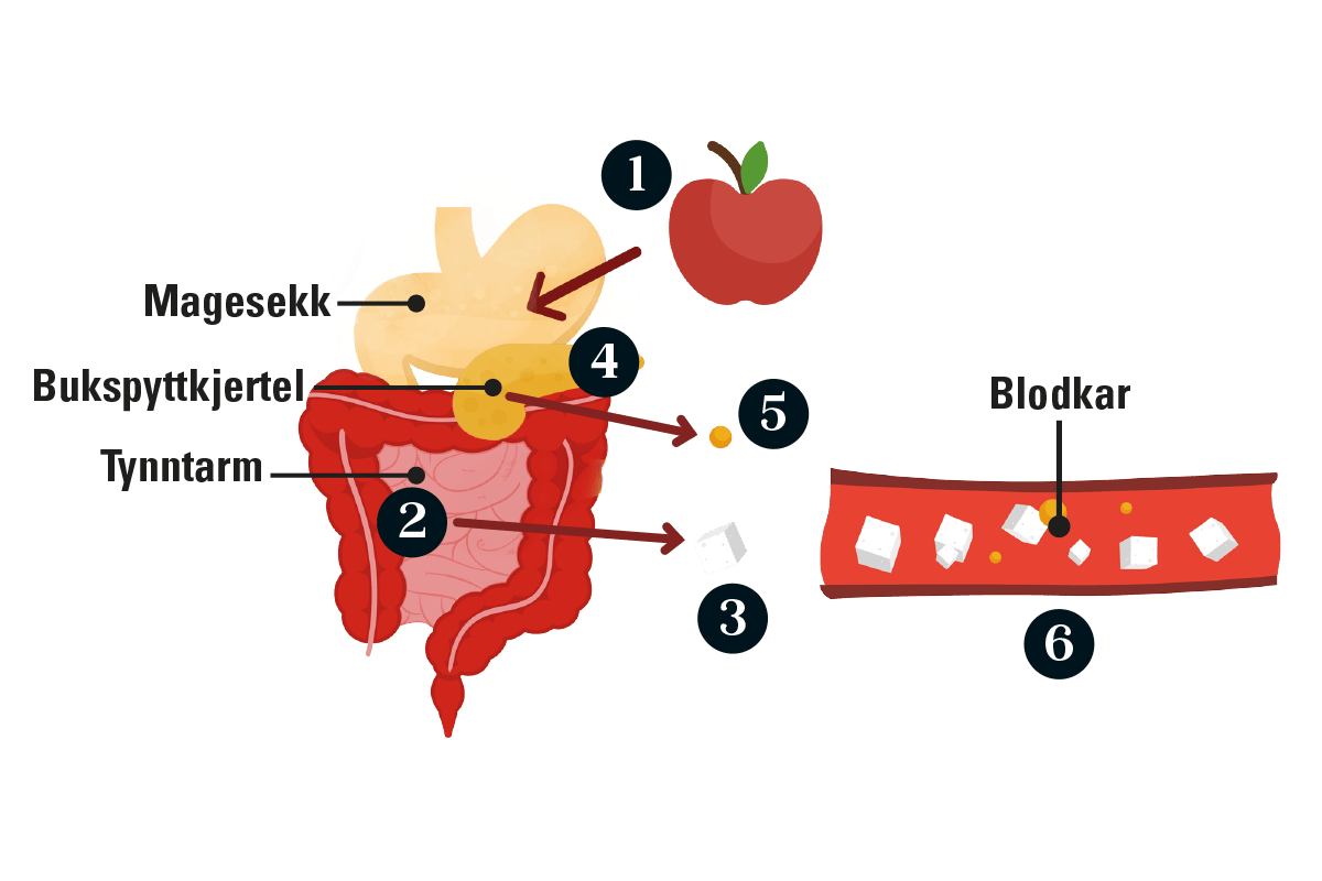 grafikk som viser hva som skjer i kroppen til en pasient med type 2-diabetes