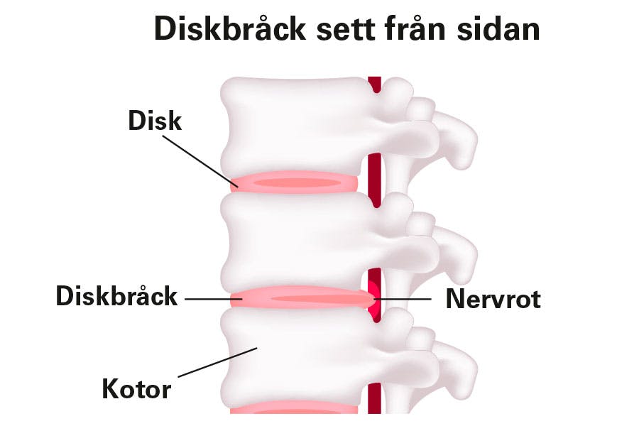 Illustration som visar en ryggrad som påverkats av ett diskbråck.