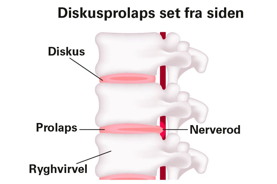 Illustration, der viser en rygsøjle, der er ramt af diskusprolaps.