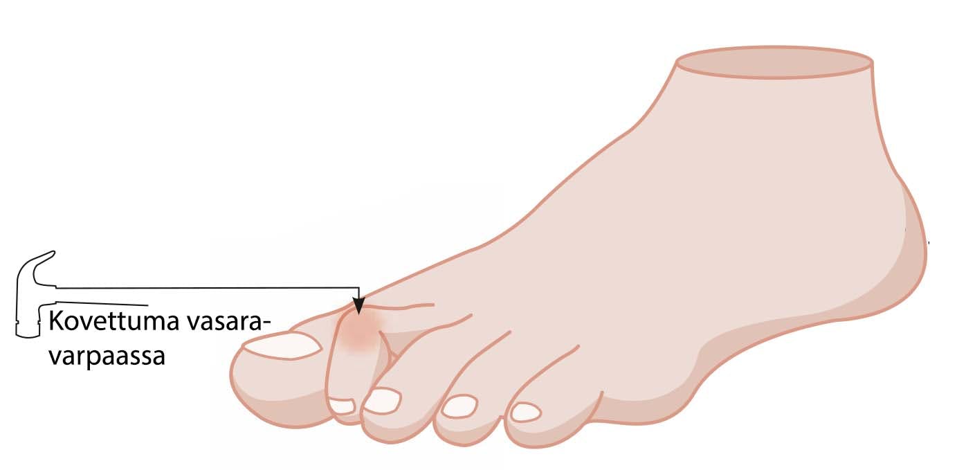 Miltä vasaravarvas näyttää?