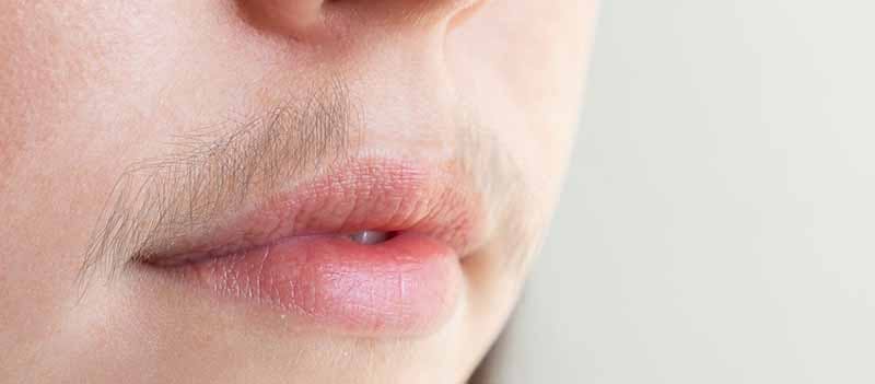 Uønsket hårvækst på overlæben