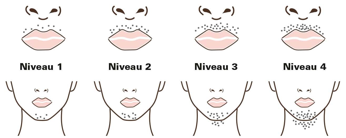 Øget hårvækst i ansigtet – hirsutisme – grafik med niveauer