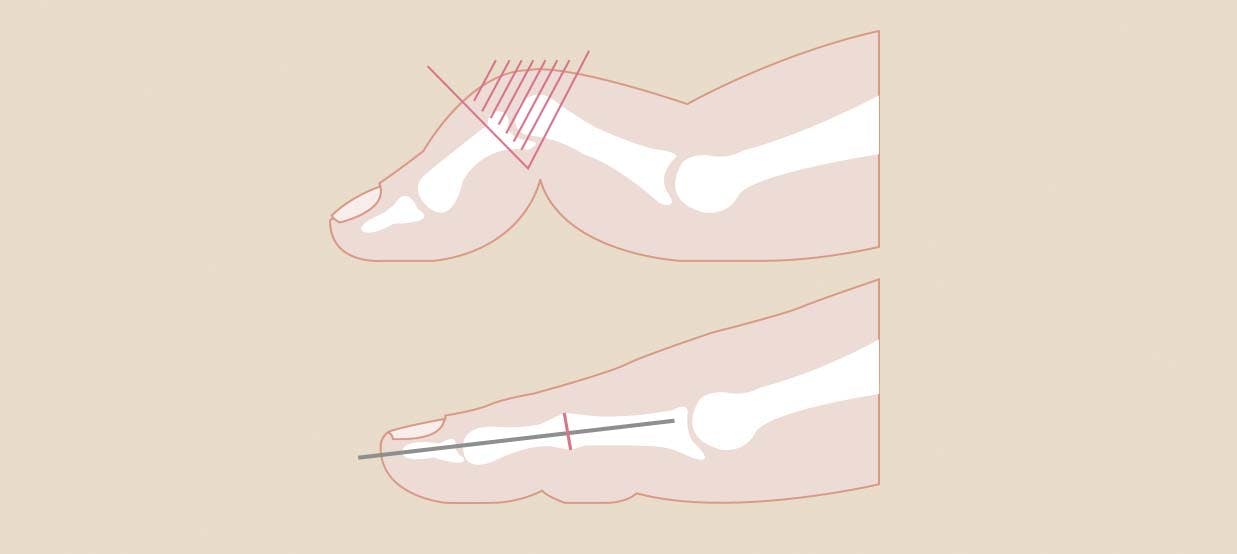 Illustration af hvordan hammertå opereres