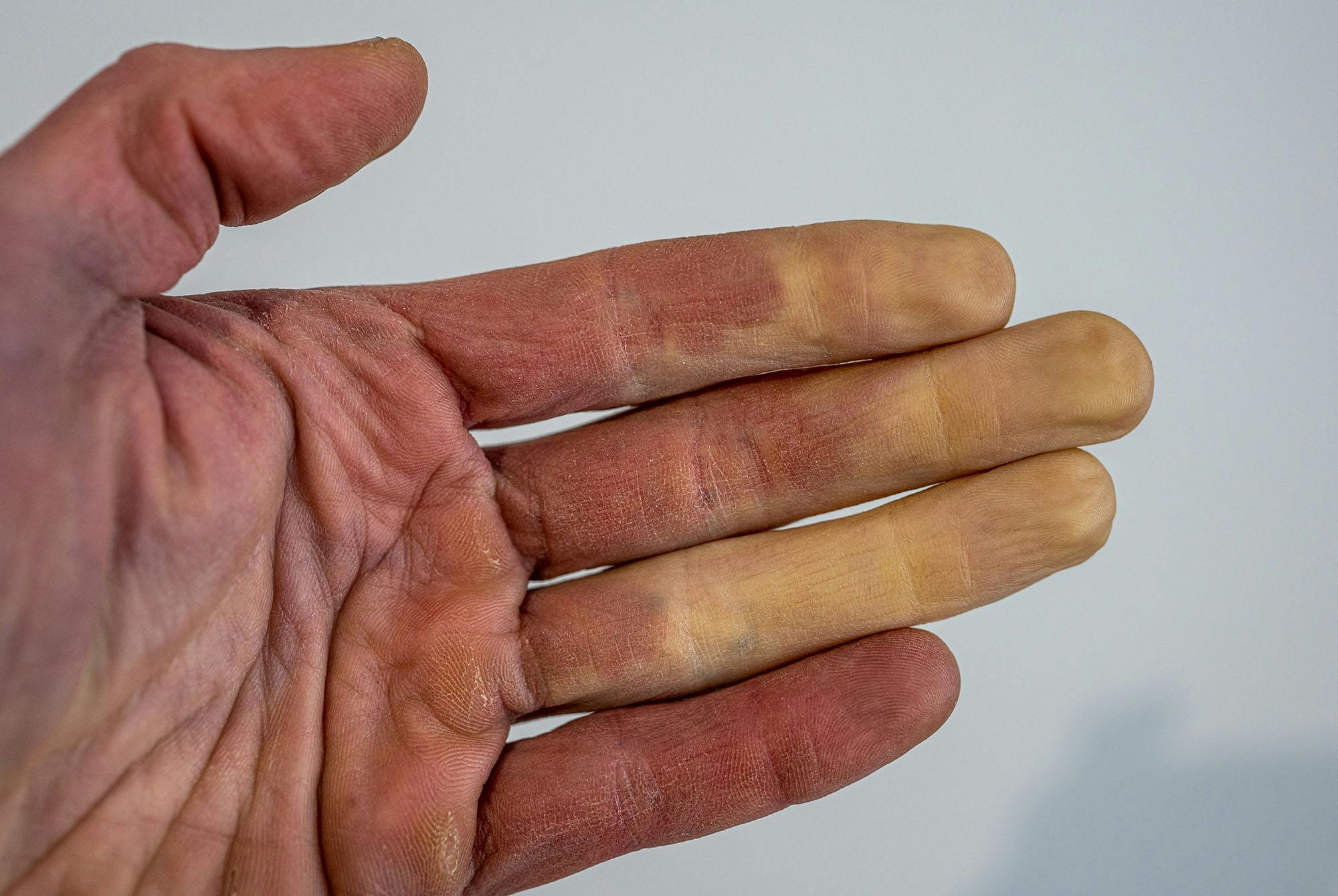 Raynaud’n ilmiö sormissa