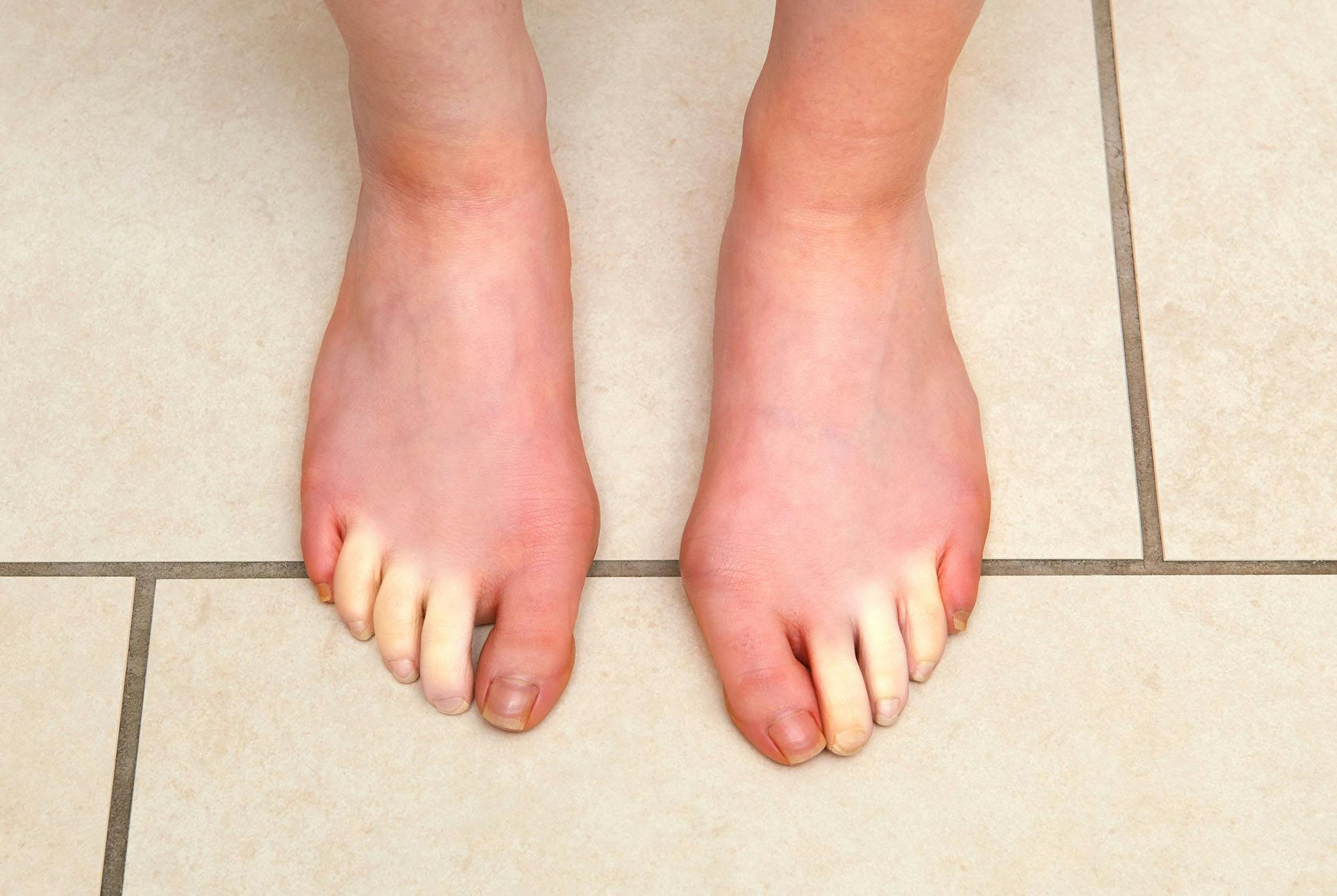 Valkoiset varpaat Raynaud’n ilmiössä