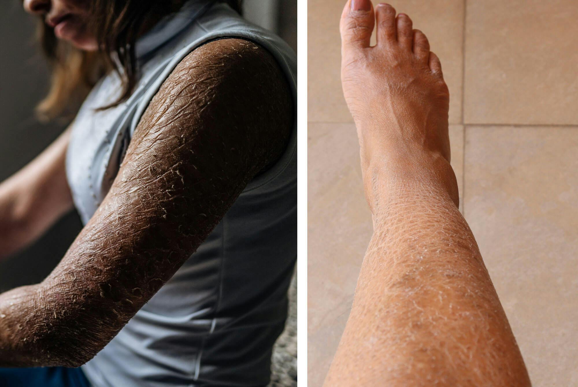 kuivat sääret ja kalansuomutauti – iktyoosi