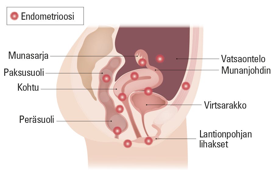 Kuva endometrioosin leviämisalueista