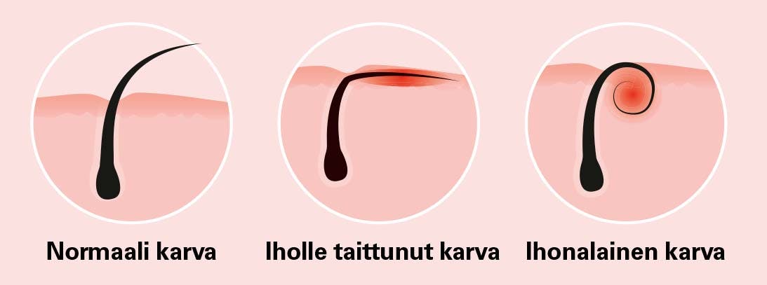 Kolmenlaisia ihokarvoja