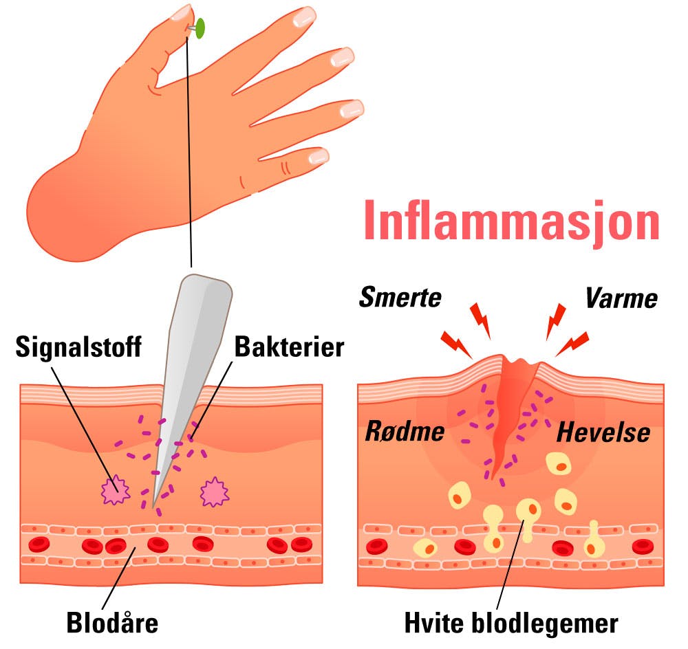 Tegning av betennelsesreaksjonen i et lite hudsår