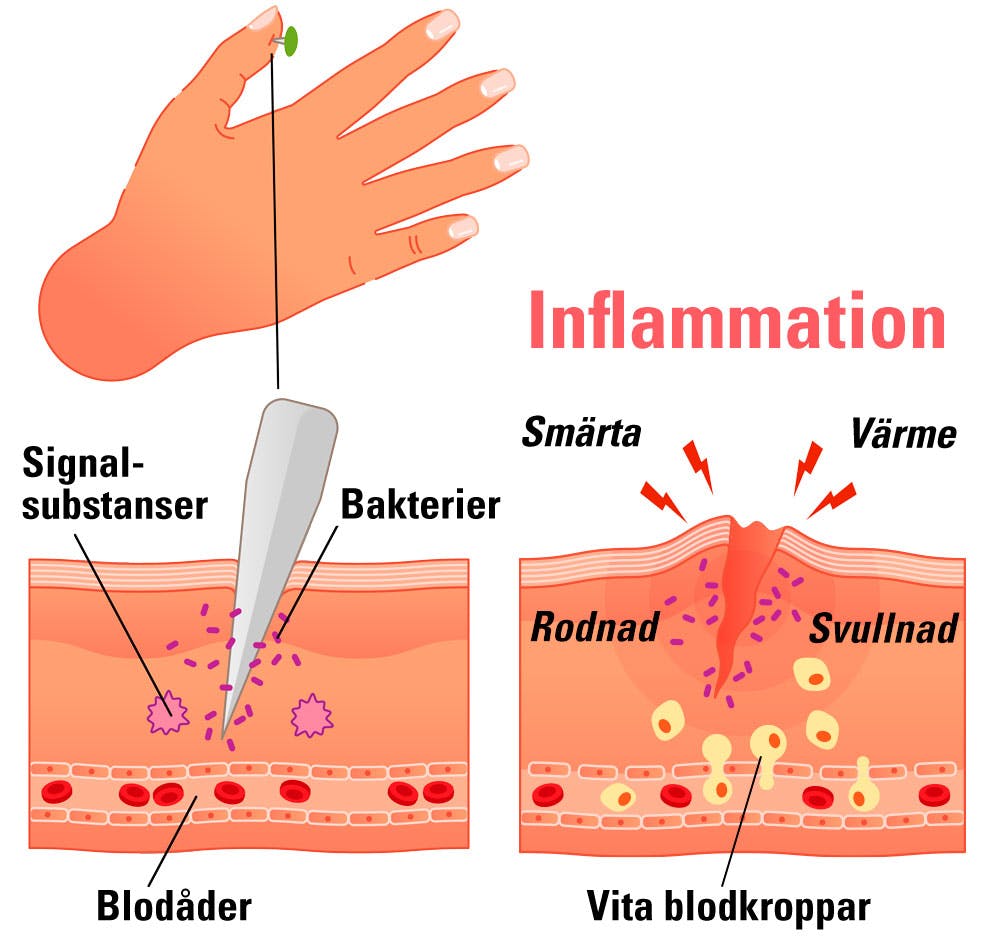 Illustration av inflammations-reaktion vid ett litet sår i huden