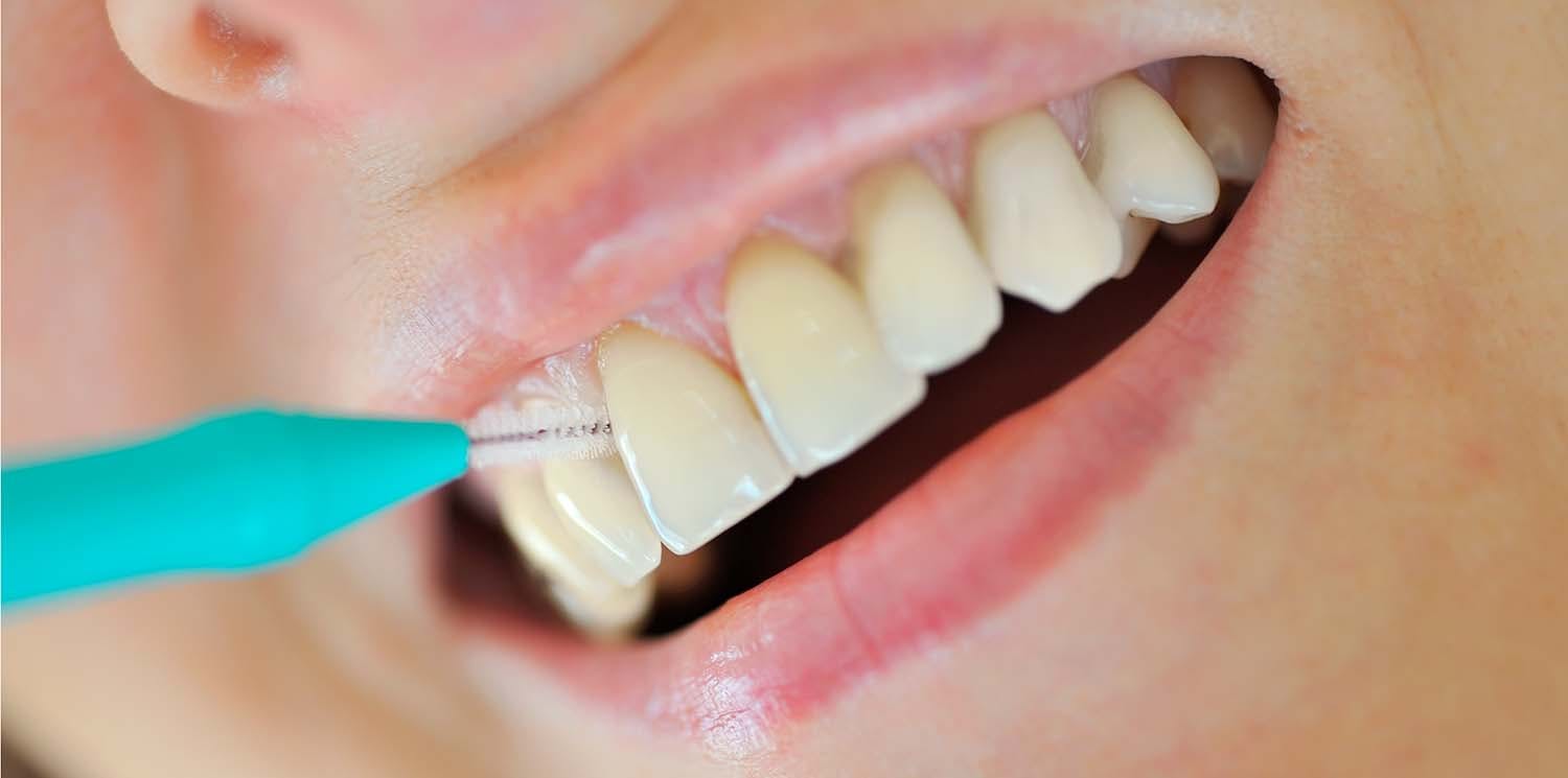 Kvinne bruker interdental- eller mellomromsbørste