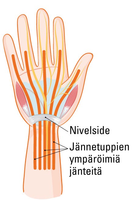 Jännetuppitulehdus ranteessa