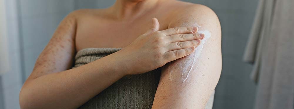 Fuktighetskräm kan förebygga och behandla knottrorna